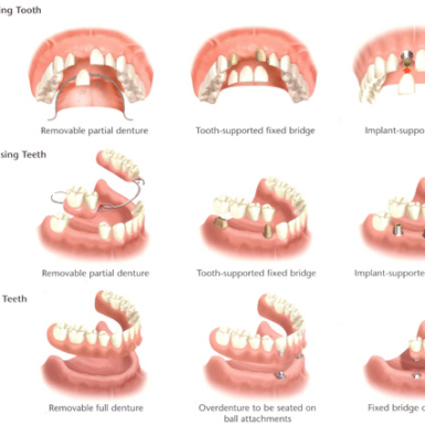 Chăm Sóc Răng Implant Như Thế Nào?