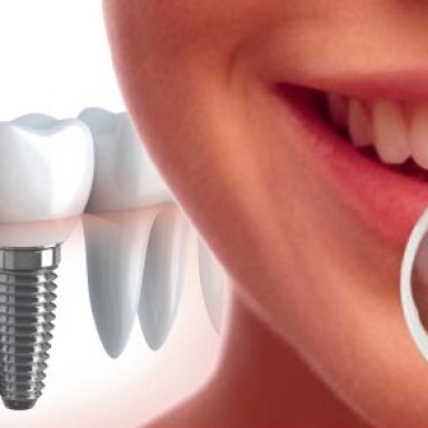 Những Điều Cần Lưu Ý Sau Khi Cấy Ghép Implant