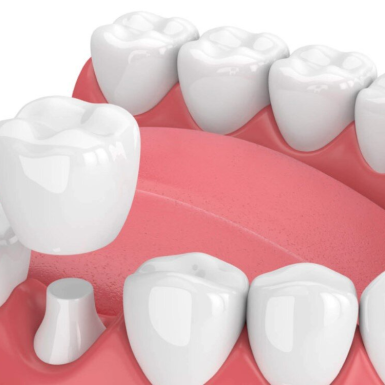 Răng bọc sứ bị hỏng có trồng lại được không? Giải đáp từ chuyên gia