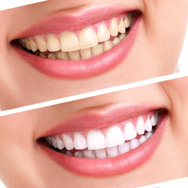 Review dịch vụ tẩy trắng răng: Công nghệ nào an toàn, không ê buốt?