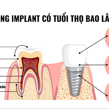 Tuổi thọ răng implant kéo dài bao lâu? Những yếu tố ảnh hưởng