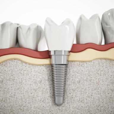 Cách nhận biết nha khoa trồng răng Implant uy tín và an toàn