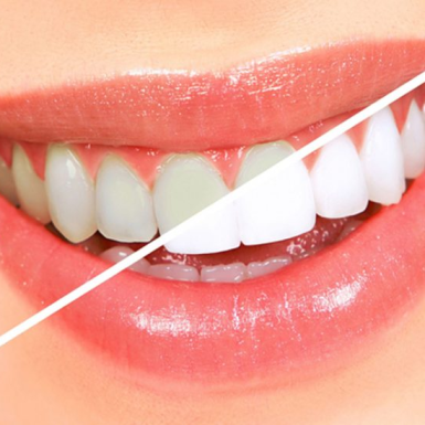 Có nên tẩy trắng răng không? 3 lưu ý quan trọng từ nha sĩ