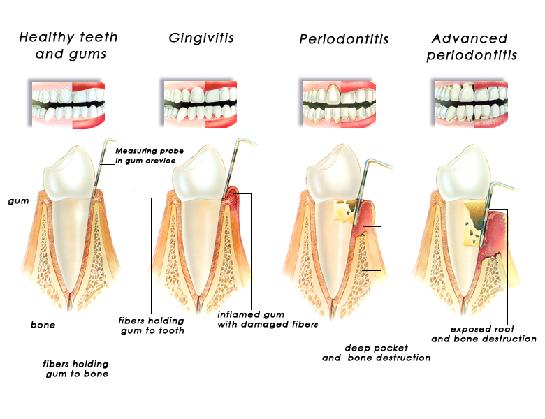 gingivitis_periodontitis