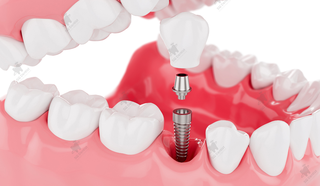 Trồng răng implant giá tốt tại Nha Khoa Xinh Xinh