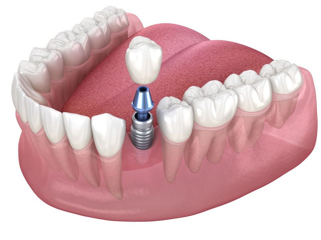Trồng Răng Implant Có Đau Không