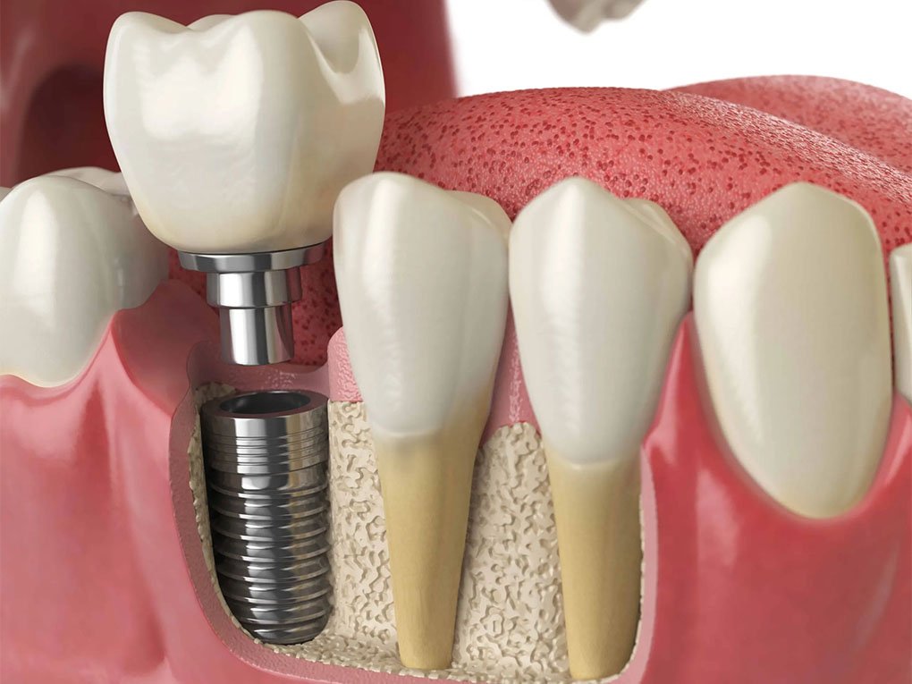 Trồng Răng Implant Có Đau Không