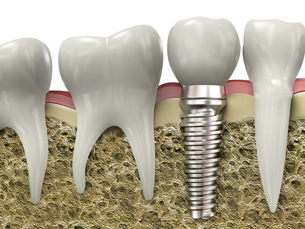 Trồng Răng Implant Có Đau Không