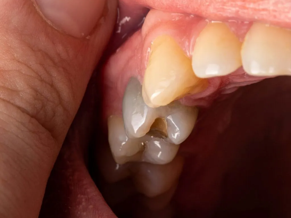 Dấu hiệu khi bị viêm tuỷ răng
