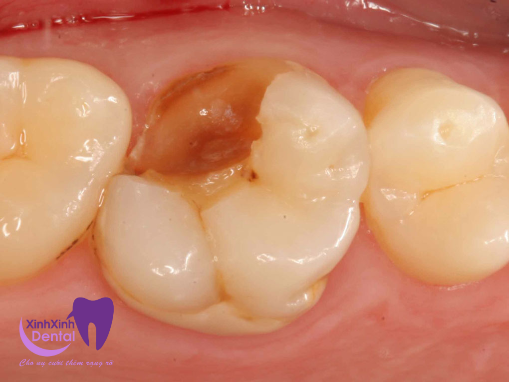 Địa chỉ diệt tuỷ răng tại Quận 1