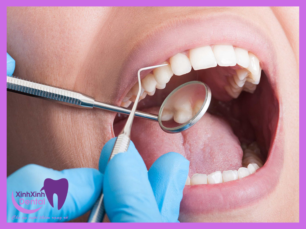 điều trị tuỷ răng tại Nha Khoa