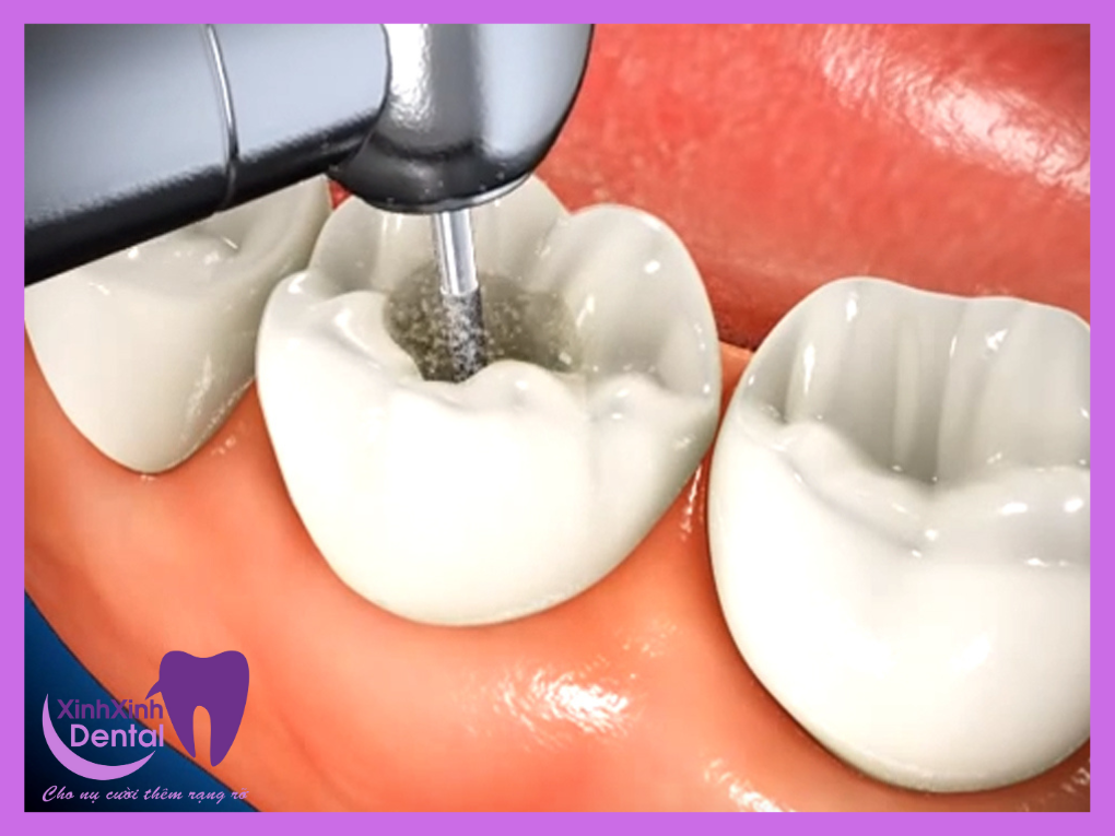 Lấy tuỷ răng có đau không