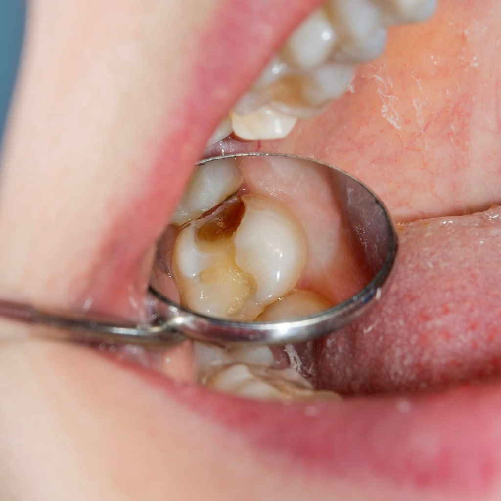 Trẻ Bị Viêm Tủy Răng