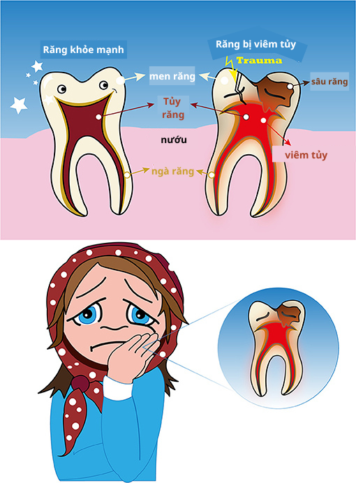 tủy răng bị hoại tử