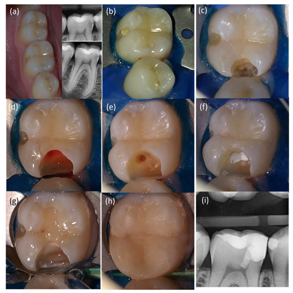 bệnh viêm tuỷ răng 