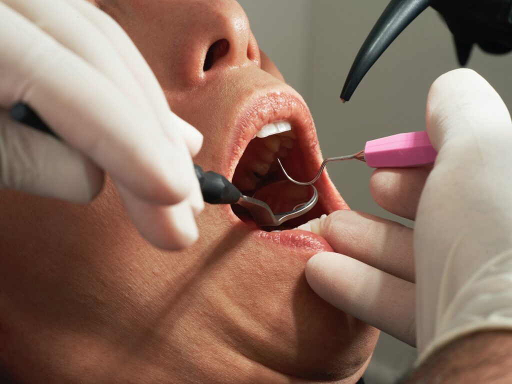 điều trị bệnh viêm tủy răng