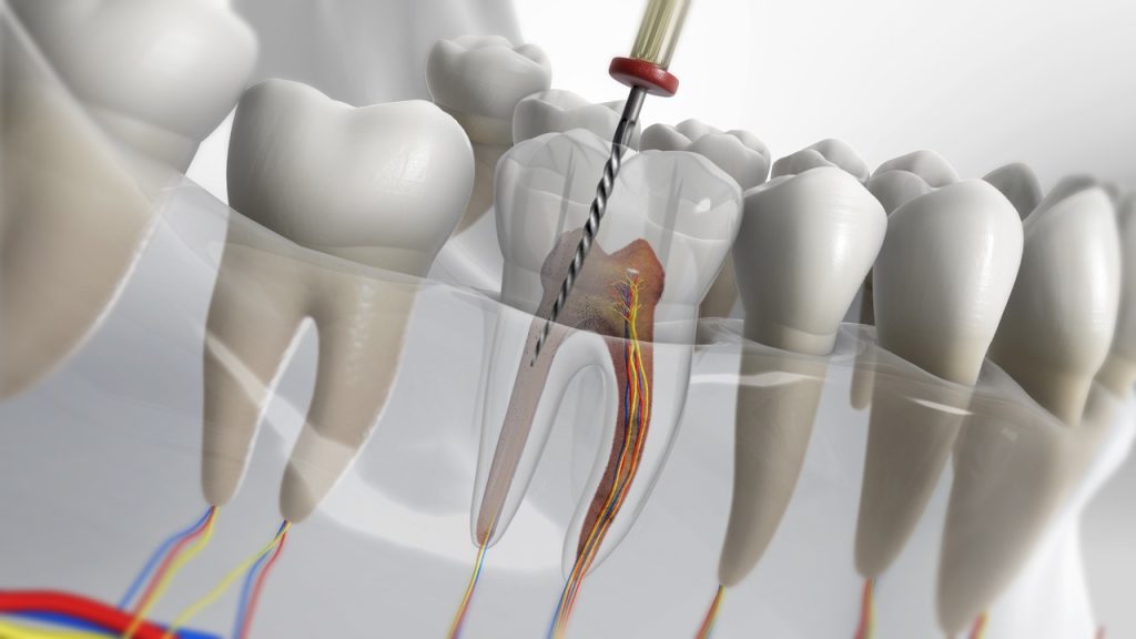 điều trị nội nha