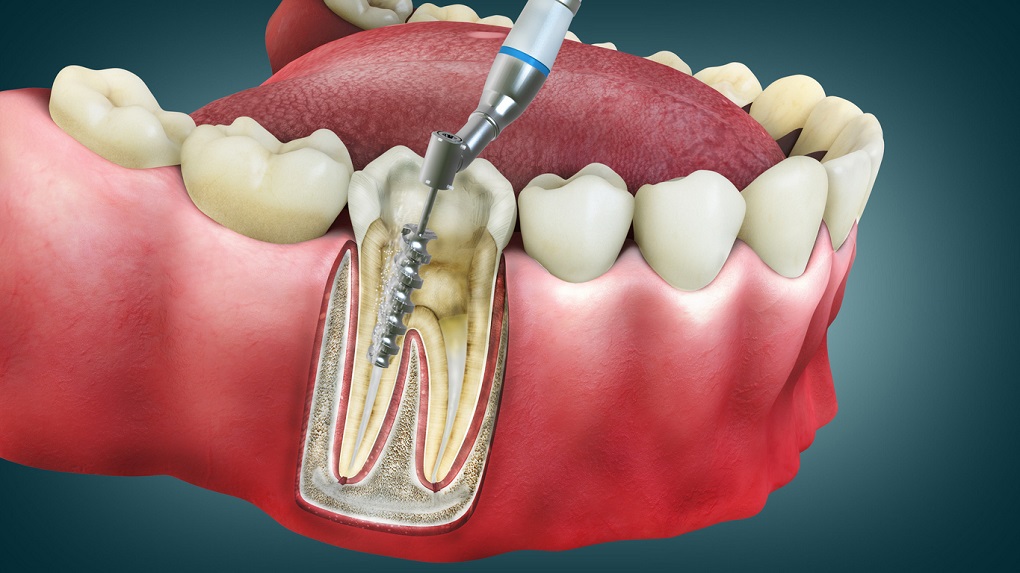 lấy tuỷ răng xong vẫn bị đau 