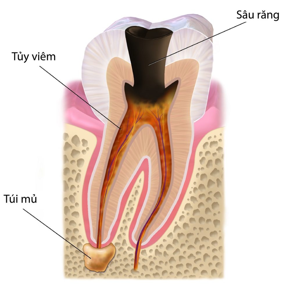viêm tủy răng có mủ