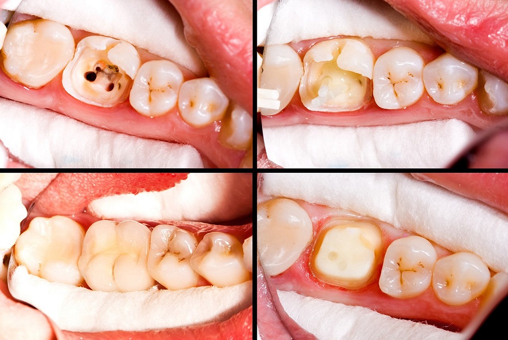 Cách Bảo Vệ Răng Sau Khi Chữa Tủy Răng