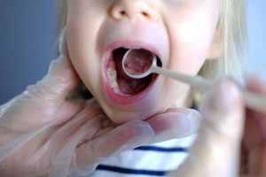 Có Nên Lấy Tuỷ Răng Sữa Ở Trẻ Em
