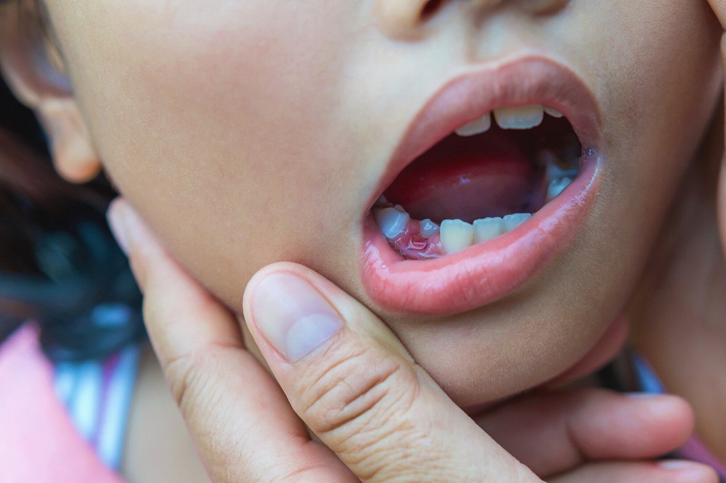 Có Nên Lấy Tuỷ Răng Sữa Ở Trẻ Em