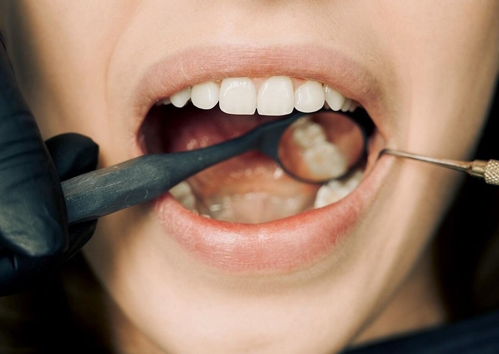 Lấy Tuỷ Răng Xong Bị Sưng