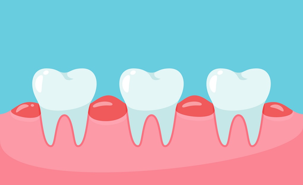 Lấy Tuỷ Răng Xong Bị Sưng