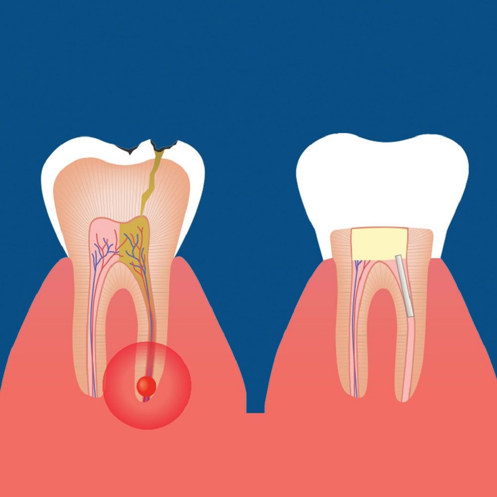 Tại Sao Răng Lấy Tuỷ bị vỡ