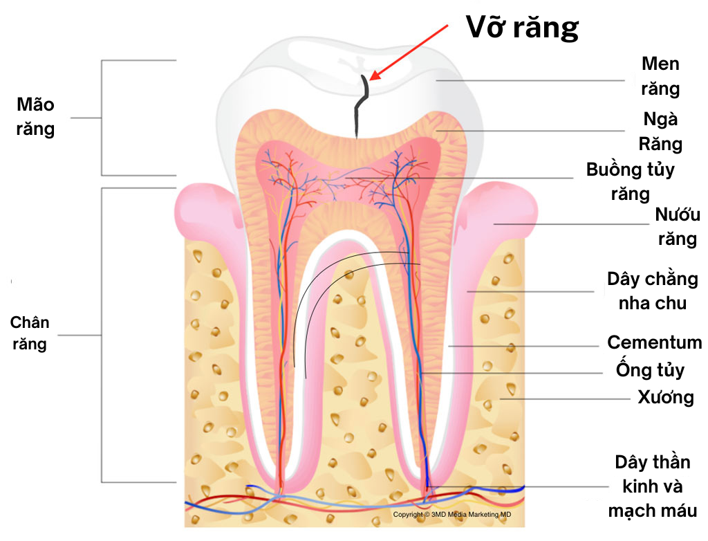 Tại Sao Răng Lấy Tuỷ bị vỡ