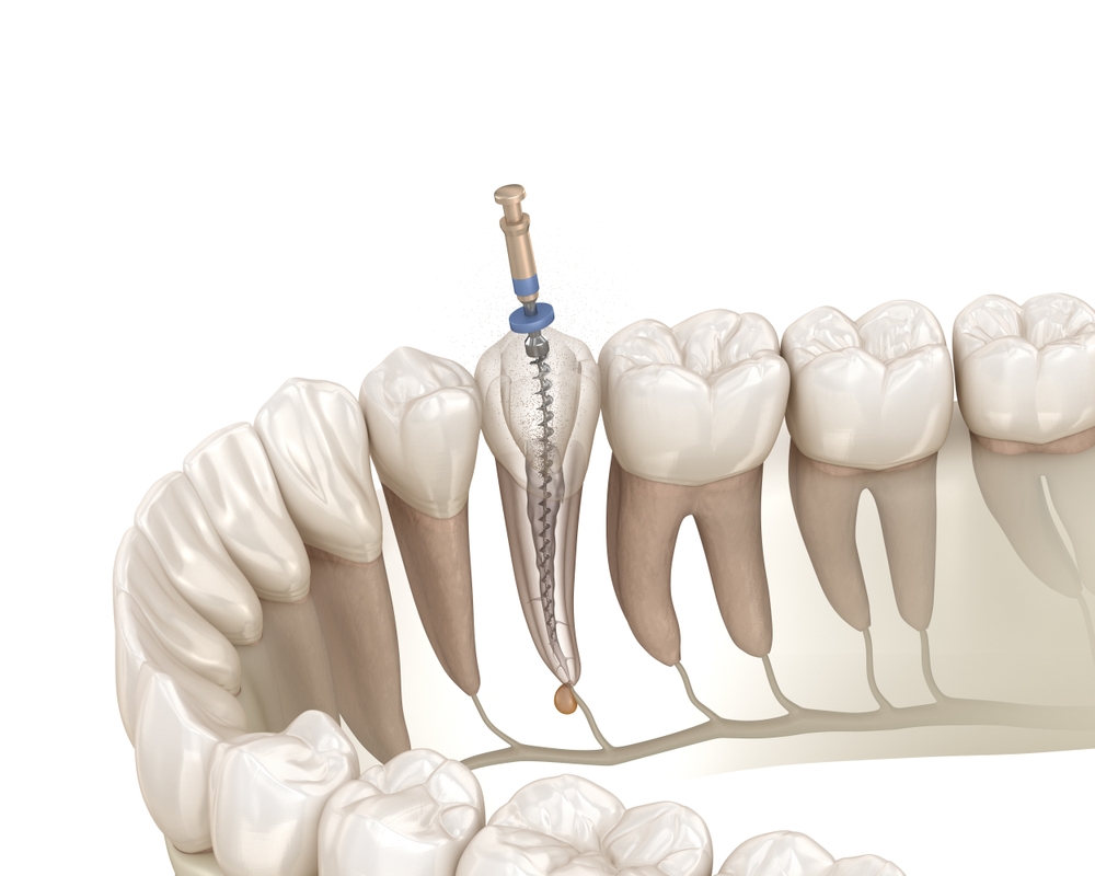 điều trị nội nha cho người cao tuổi