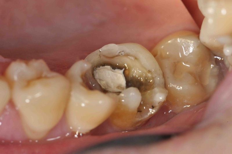 điều trị nội nha cho người cao tuổi