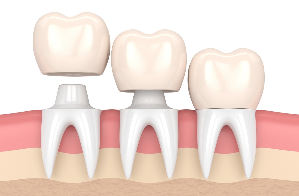 Bọc răng sứ có cần phải lấy tuỷ không