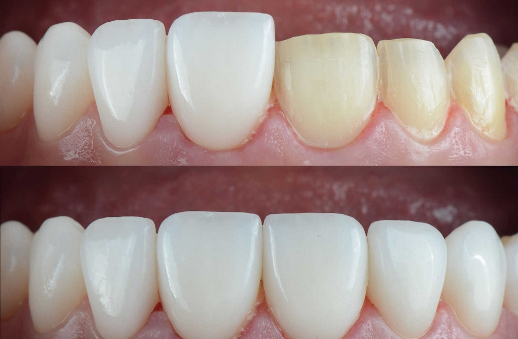 Bọc răng sứ có cần phải lấy tuỷ không 