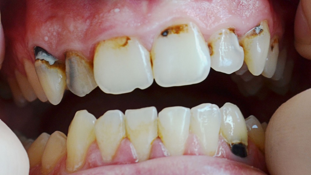 Cao Răng Tích Tụ Gây Nên Bệnh Nha Chu