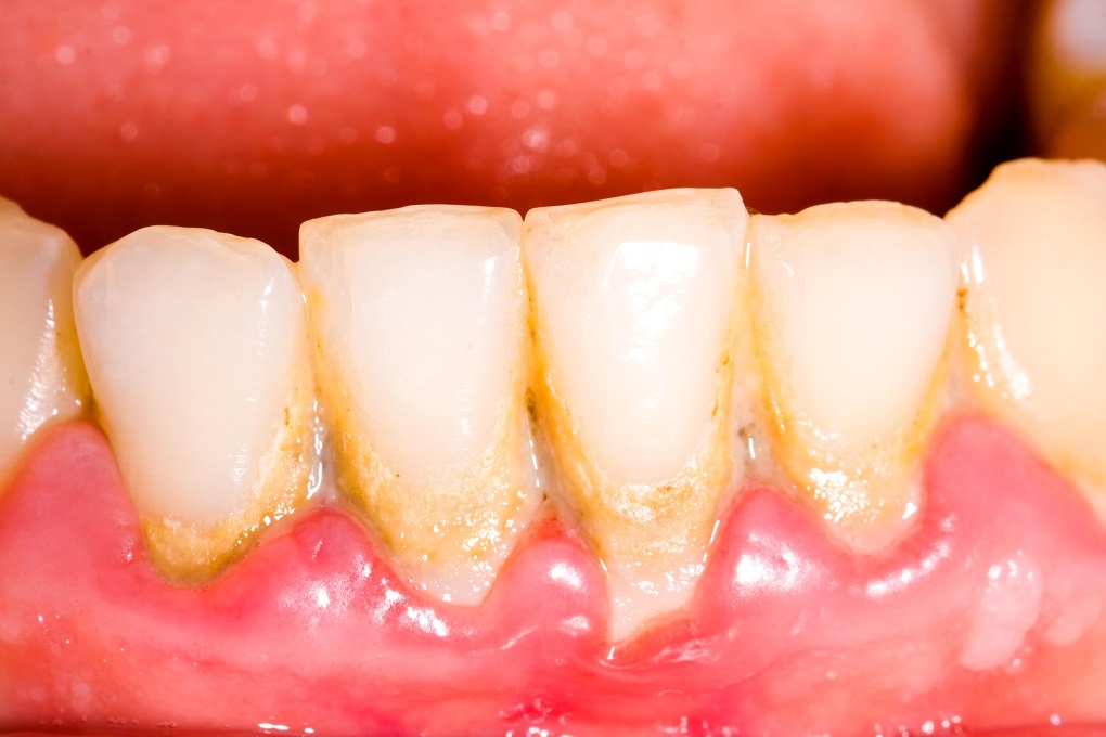 Cao Răng Tích Tụ Gây Nên Bệnh Nha Chu