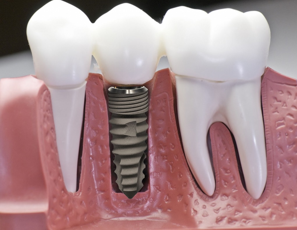 Công Nghệ Trồng Răng Implant