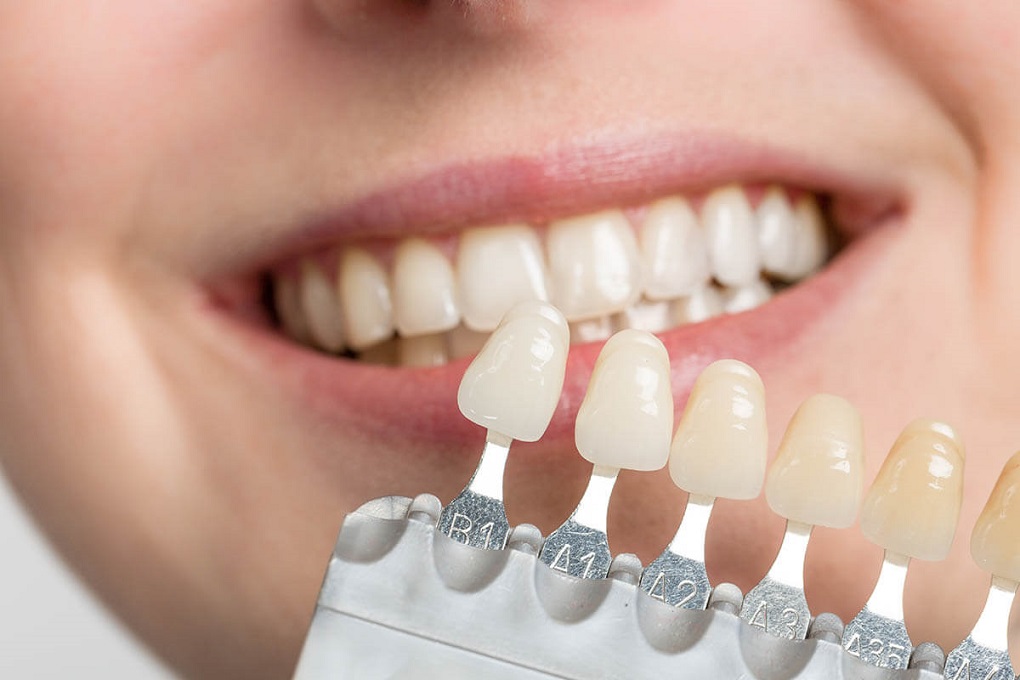 Nên Cầu Răng Sứ hay Trồng Răng Implant