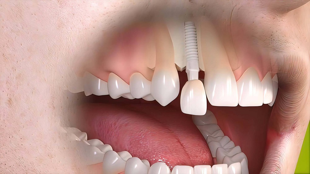 Nên Cầu Răng Sứ hay Trồng Răng Implant