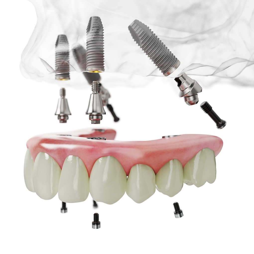 Trồng Răng Implant