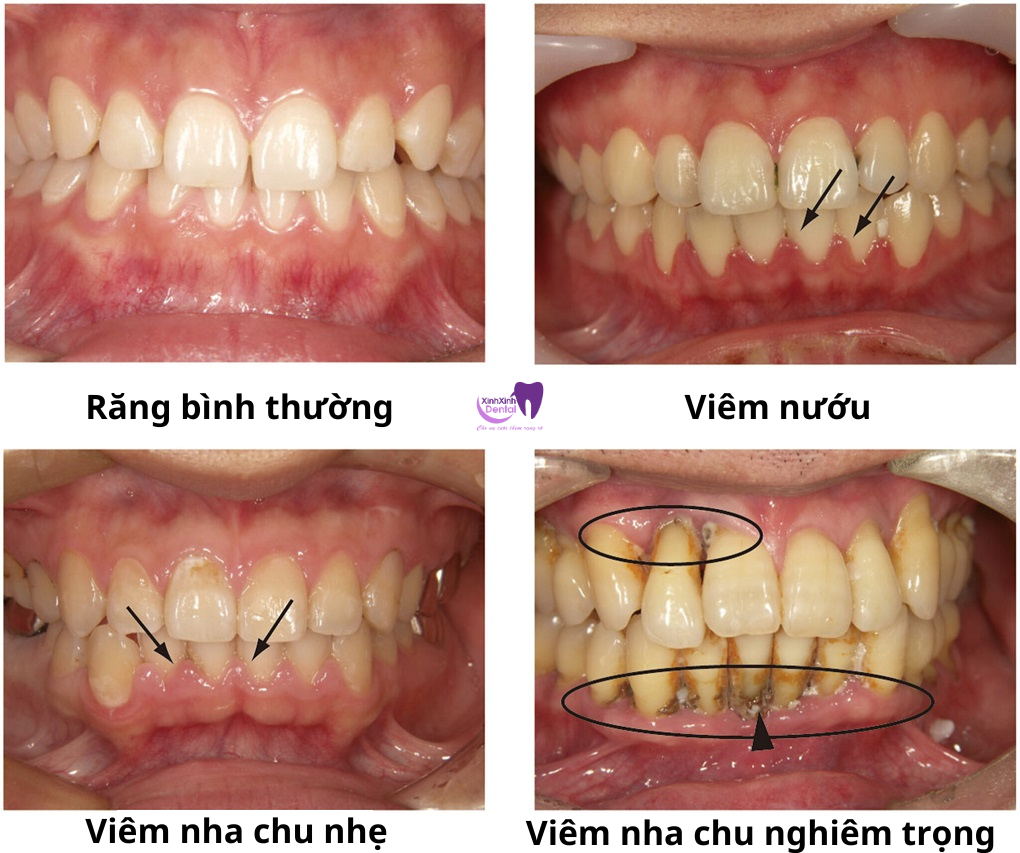 viêm nha chu