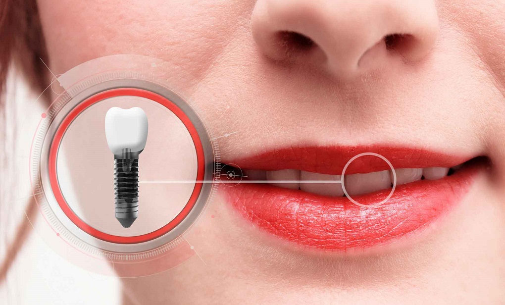 Những Lưu Ý Sau Khi Cấy Ghép Implant 