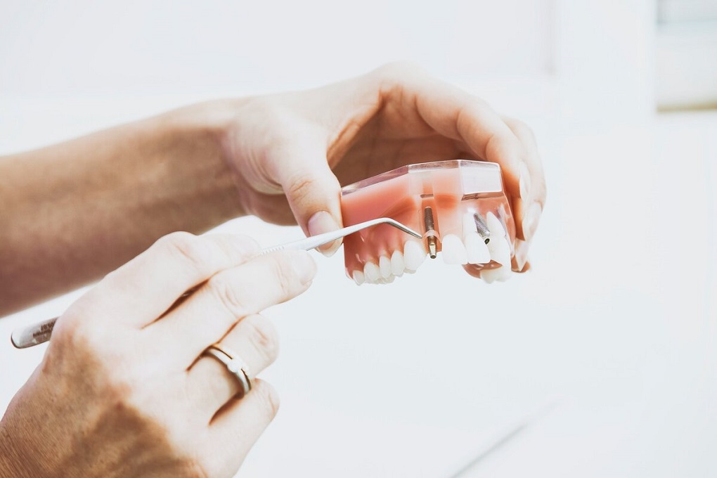 Những Lưu Ý Sau Khi Cấy Ghép Implant 
