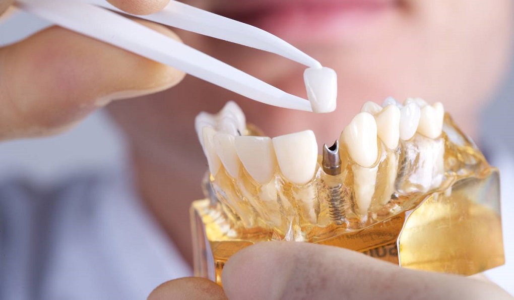 Những Việc Cần Làm Trước Khi Trồng Răng Implant 