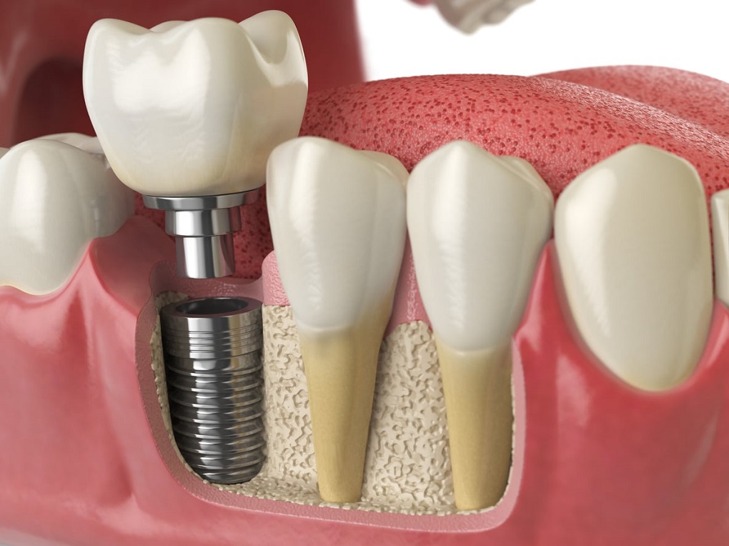 Những Việc Cần Làm Trước Khi Trồng Răng Implant