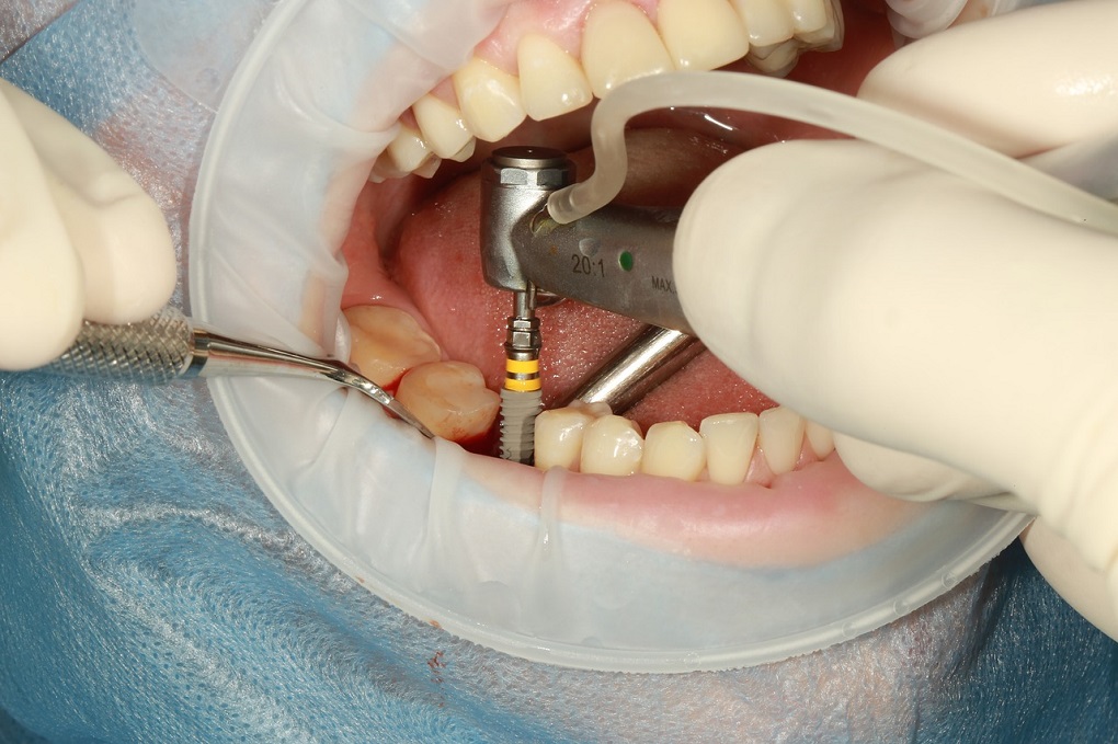 Quy Trình Cấy Ghép Implant Tại Nha Khoa 