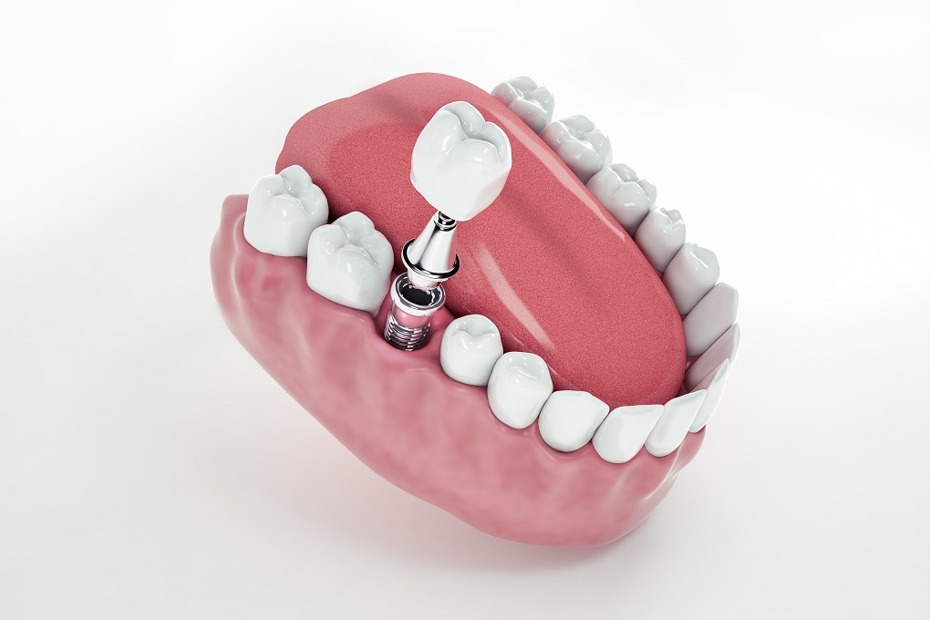Quy Trình Cấy Ghép Implant Tại Nha Khoa 