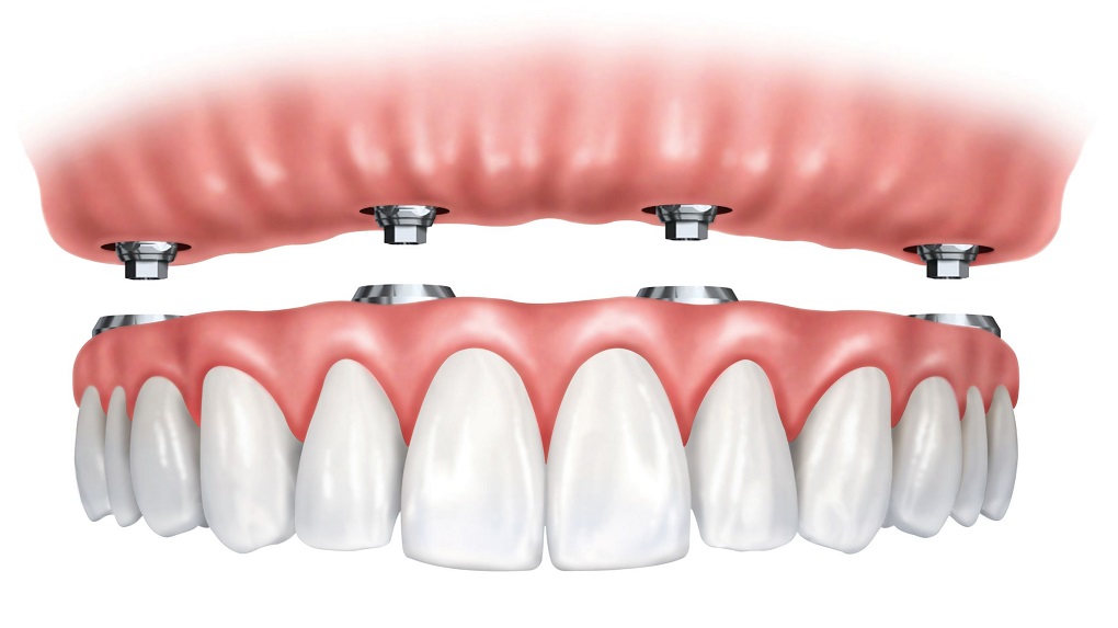 Trồng Răng Implant Nguyên Hàm