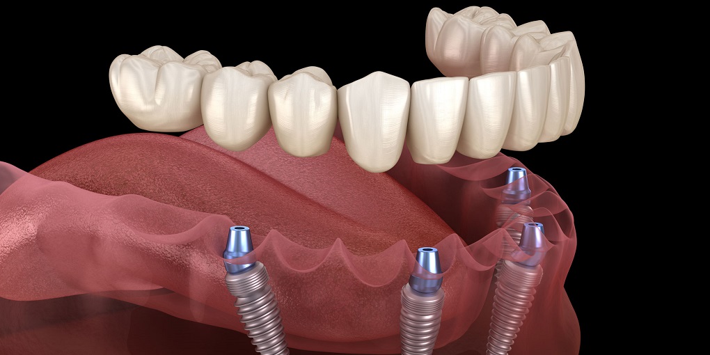 Trồng Răng Implant Nguyên Hàm