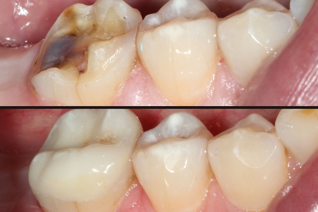 Những Biến Chứng Nguy Hiểm Khi Cấy Ghép Implant Quá Trễ